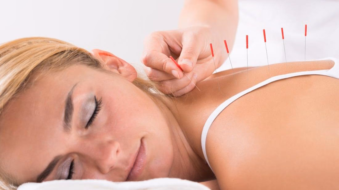 Which is more effective, dry needling or acupuncture?