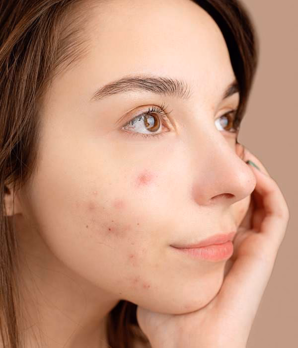 How long does acupuncture take to work for acne?