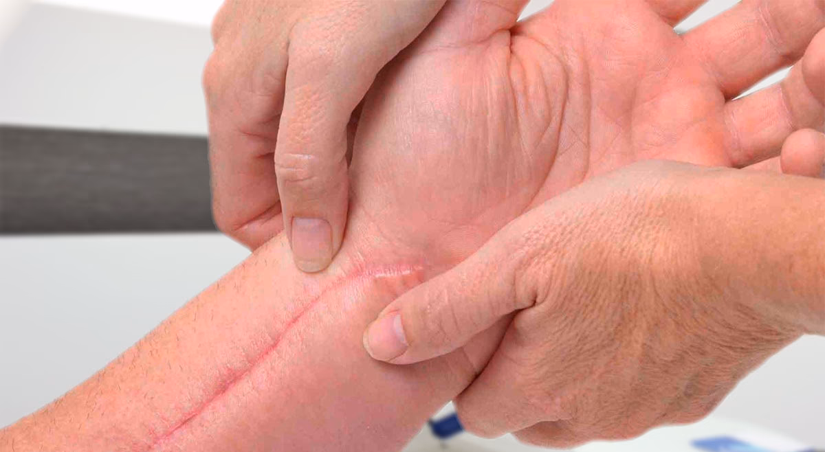 ¿Puede la acupuntura disolver las adherencias?