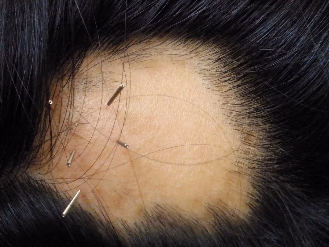 Can acupuncture help androgenic alopecia?