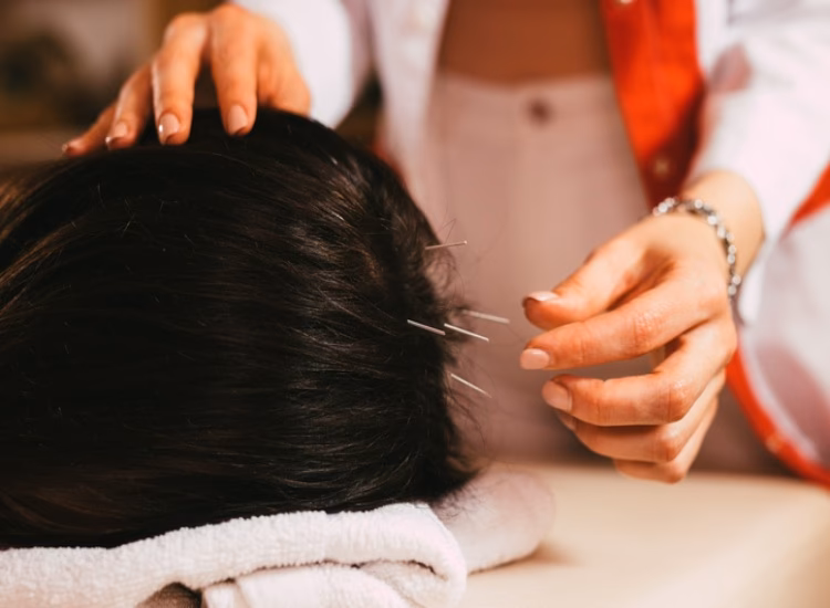 Can acupuncture help androgenic alopecia?