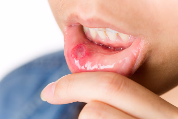 What is the drug of choice for Behcet's disease?