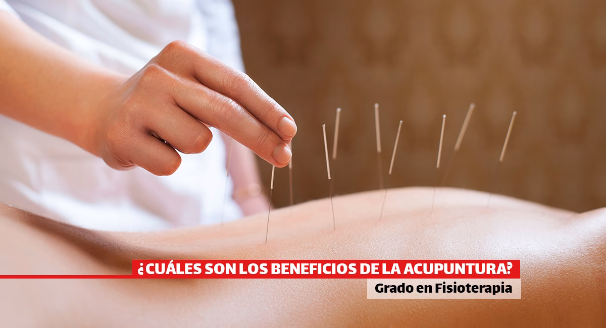 ¿Qué tan beneficiosa es la acupuntura?