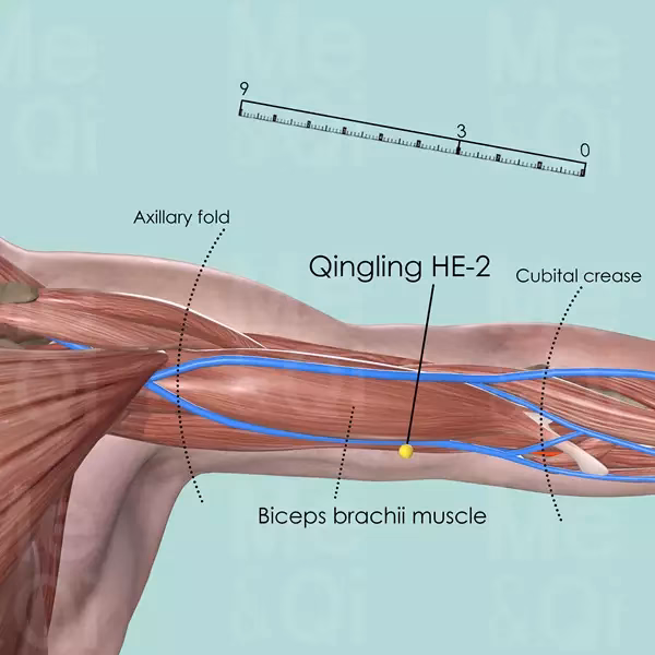 Does acupuncture work for bicep tendonitis?