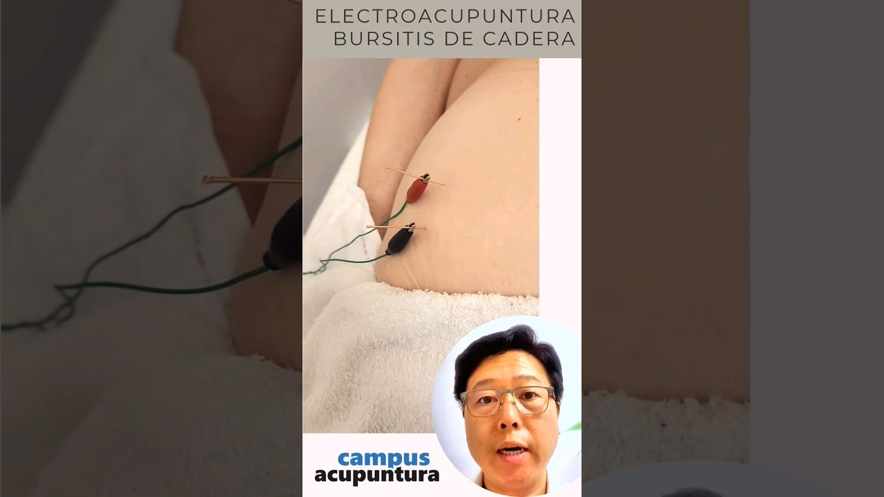 Will acupuncture help with bursitis?