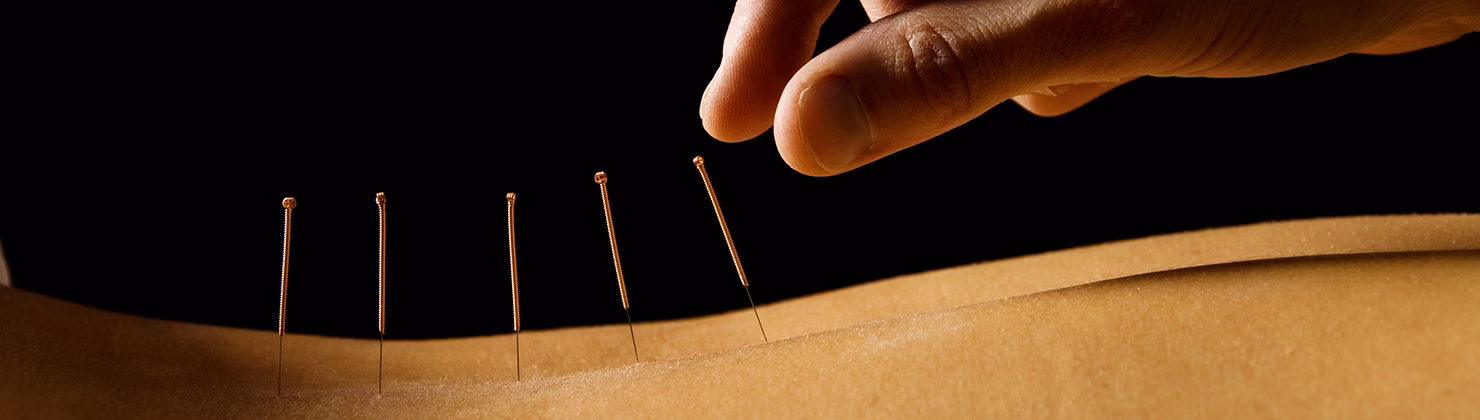 ¿Cuanto cuesta la acupuntura médica?