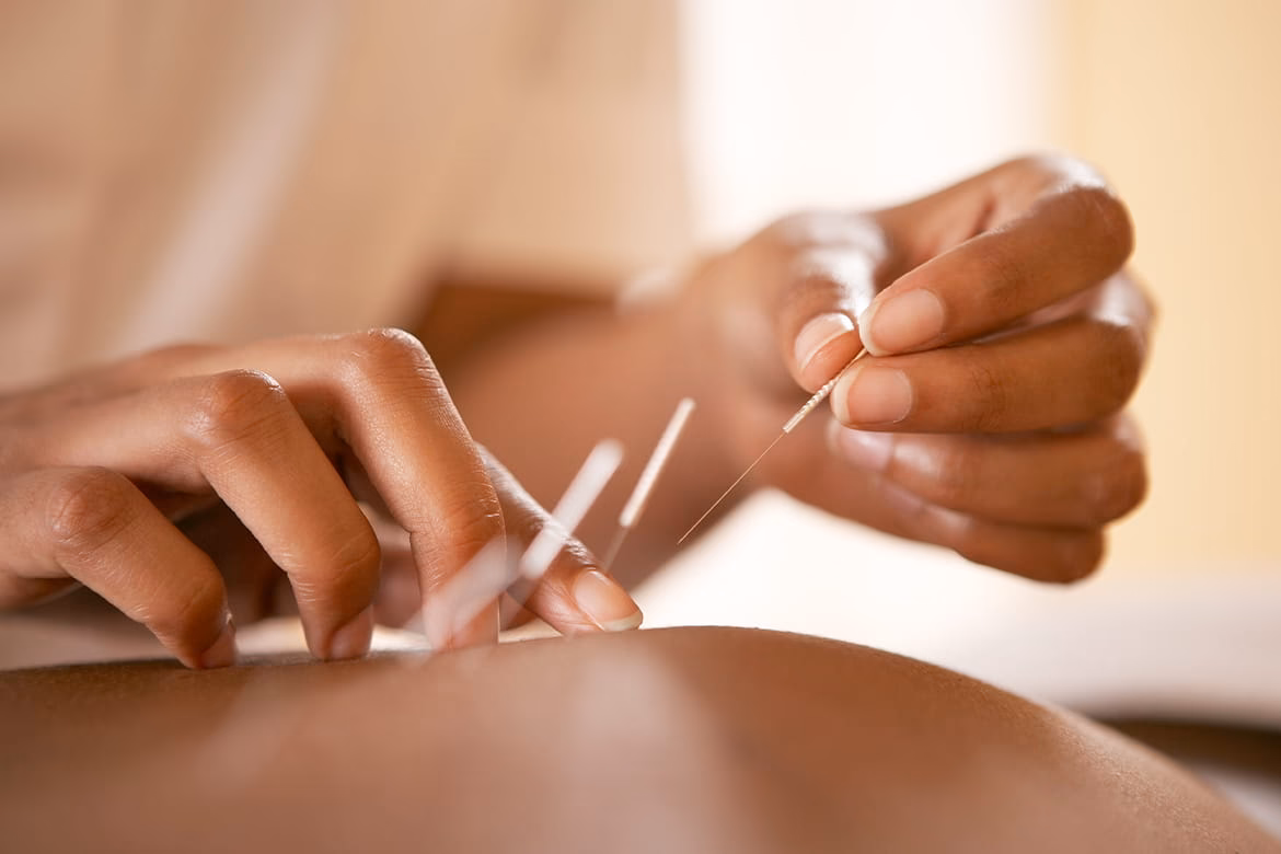 ¿Cuál es la diferencia entre la acupuntura china y la americana?