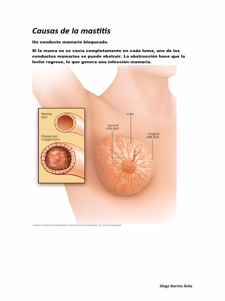 ¿Cómo desinflamar los conductos mamarios?