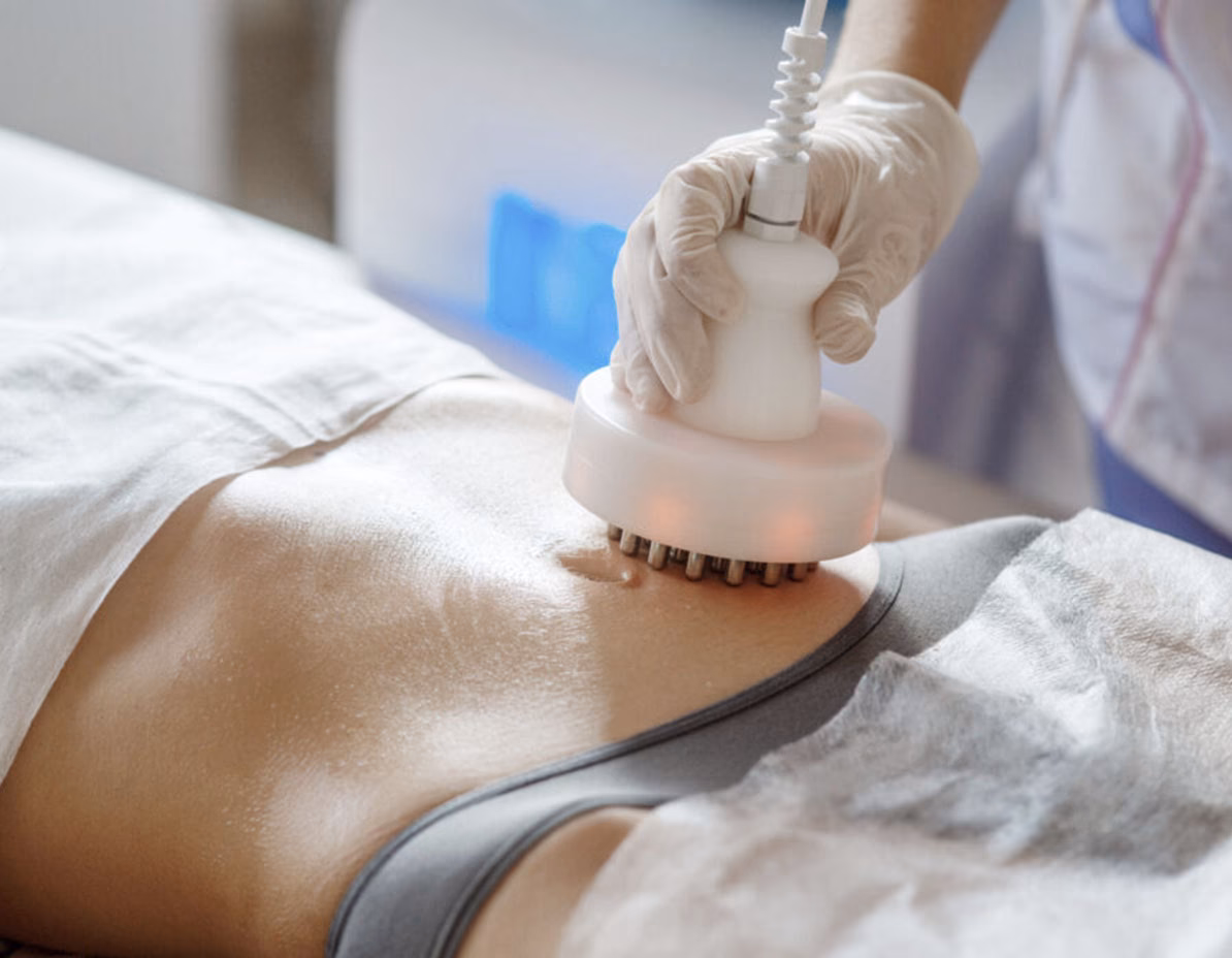 ¿Para qué se utiliza la radiofrecuencia corporal?