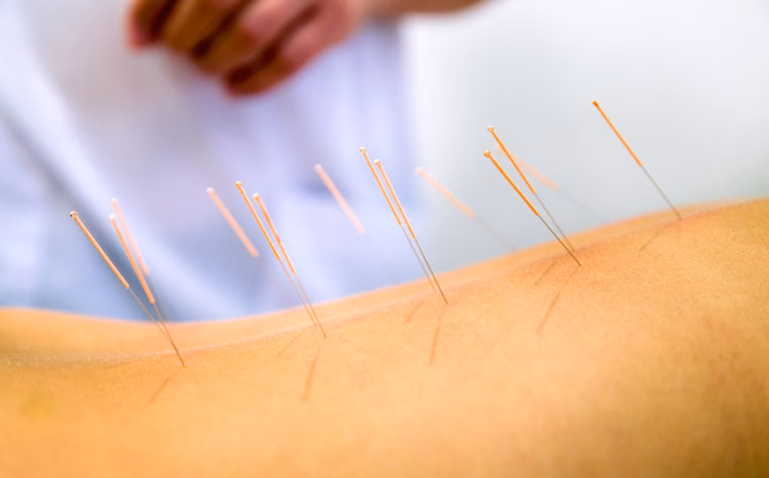 How long does it take for acupuncture to work for stress?