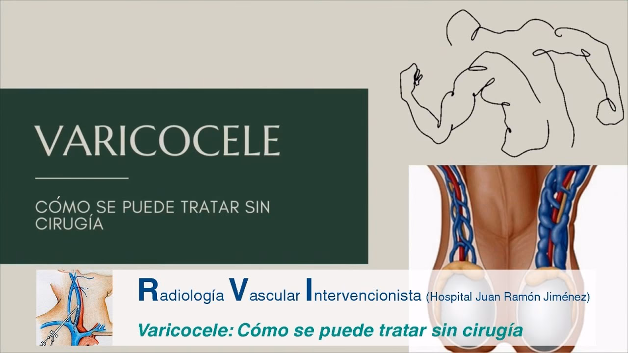 Can acupuncture help with varicocele?