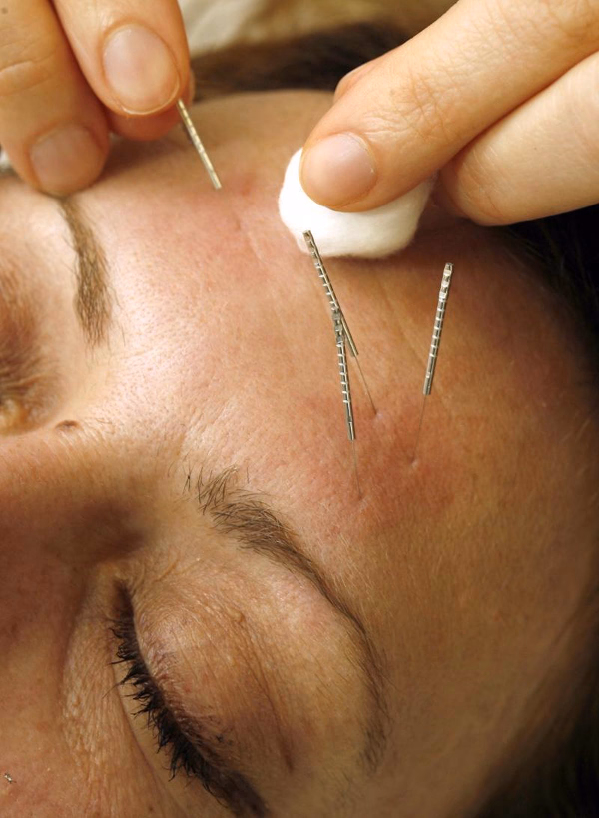 ¿Cómo sacar el dolor de cabeza con acupuntura?