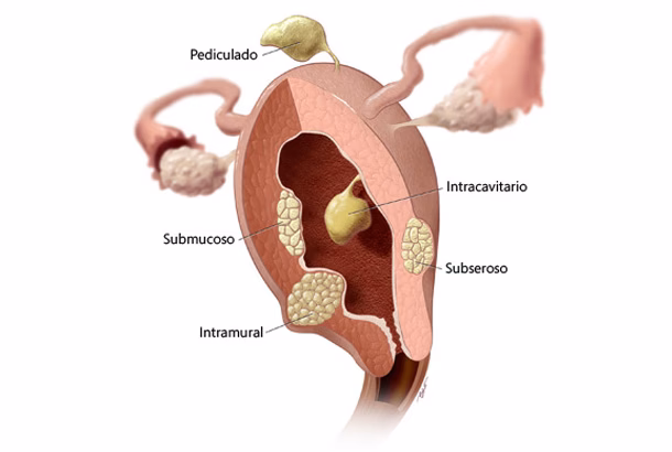 ¿Puede la acupuntura ayudar con los fibromas uterinos?