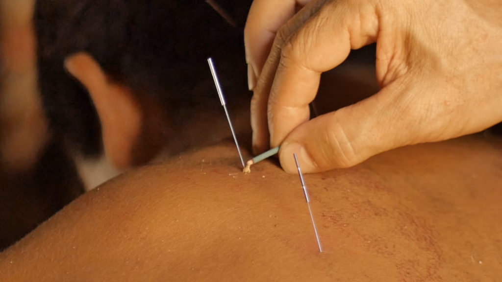 ¿Qué es la acupuntura japonesa?