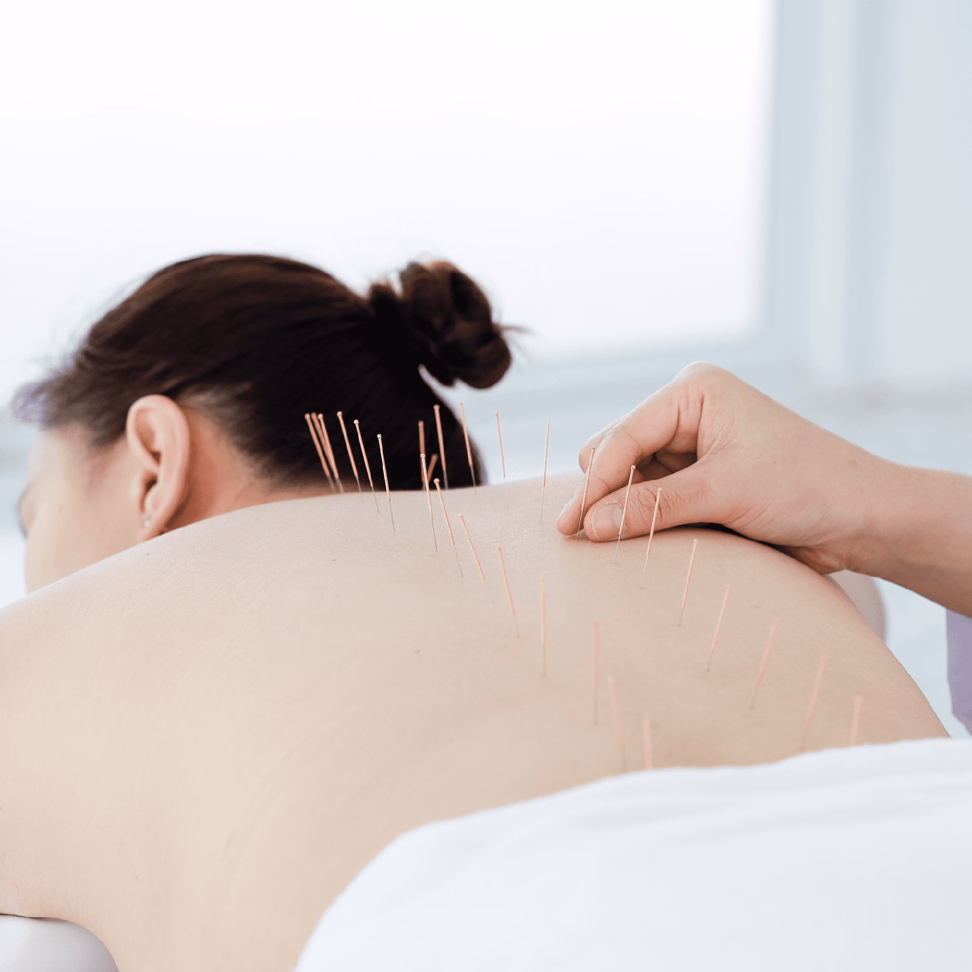 Quantos dias dura o efeito da acupuntura?