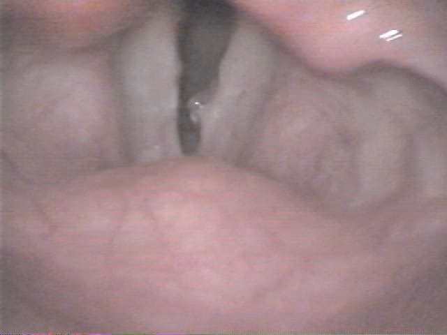 ¿La acupuntura ayuda a la disfonía espasmódica?