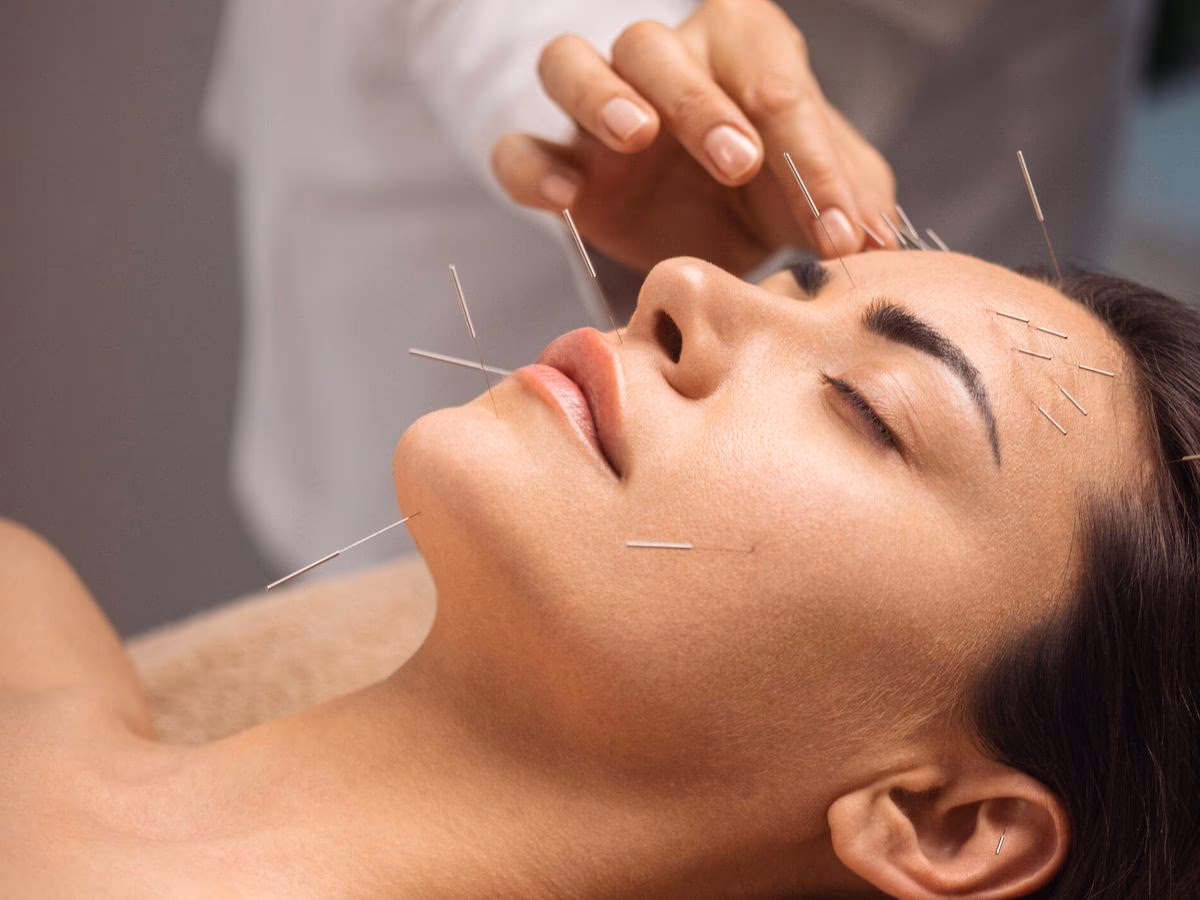 ¿Cuáles son los beneficios de la acupuntura en la cabeza?