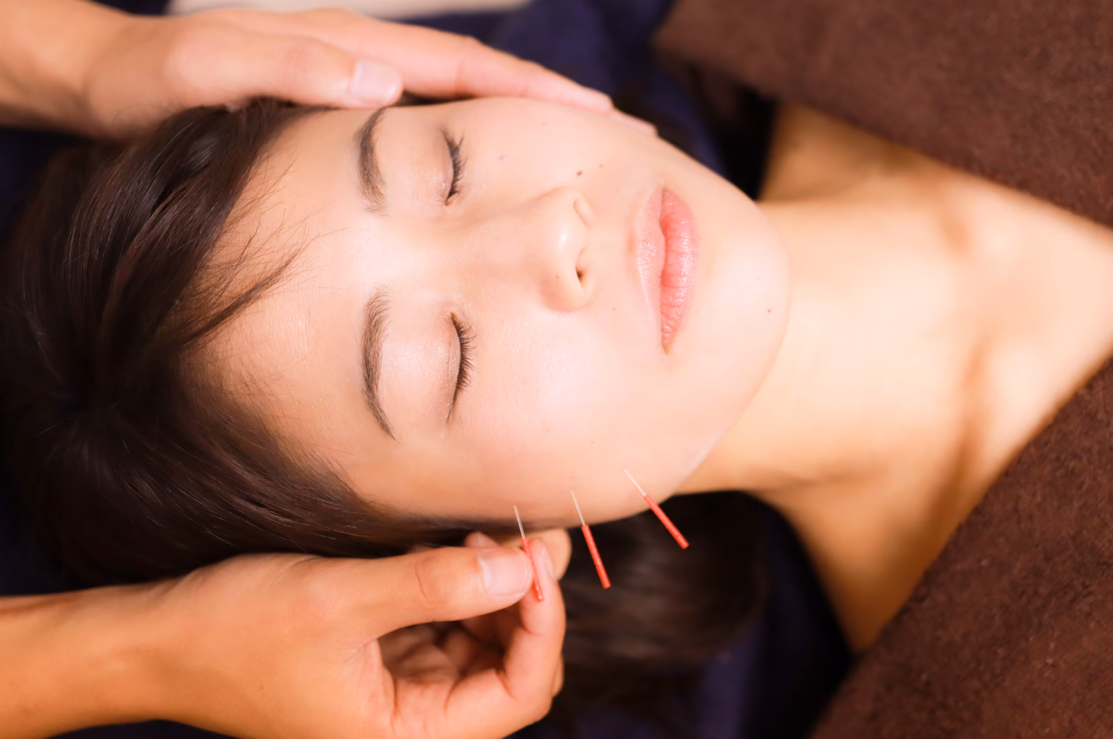¿Puede la acupuntura ayudar con la mandíbula?