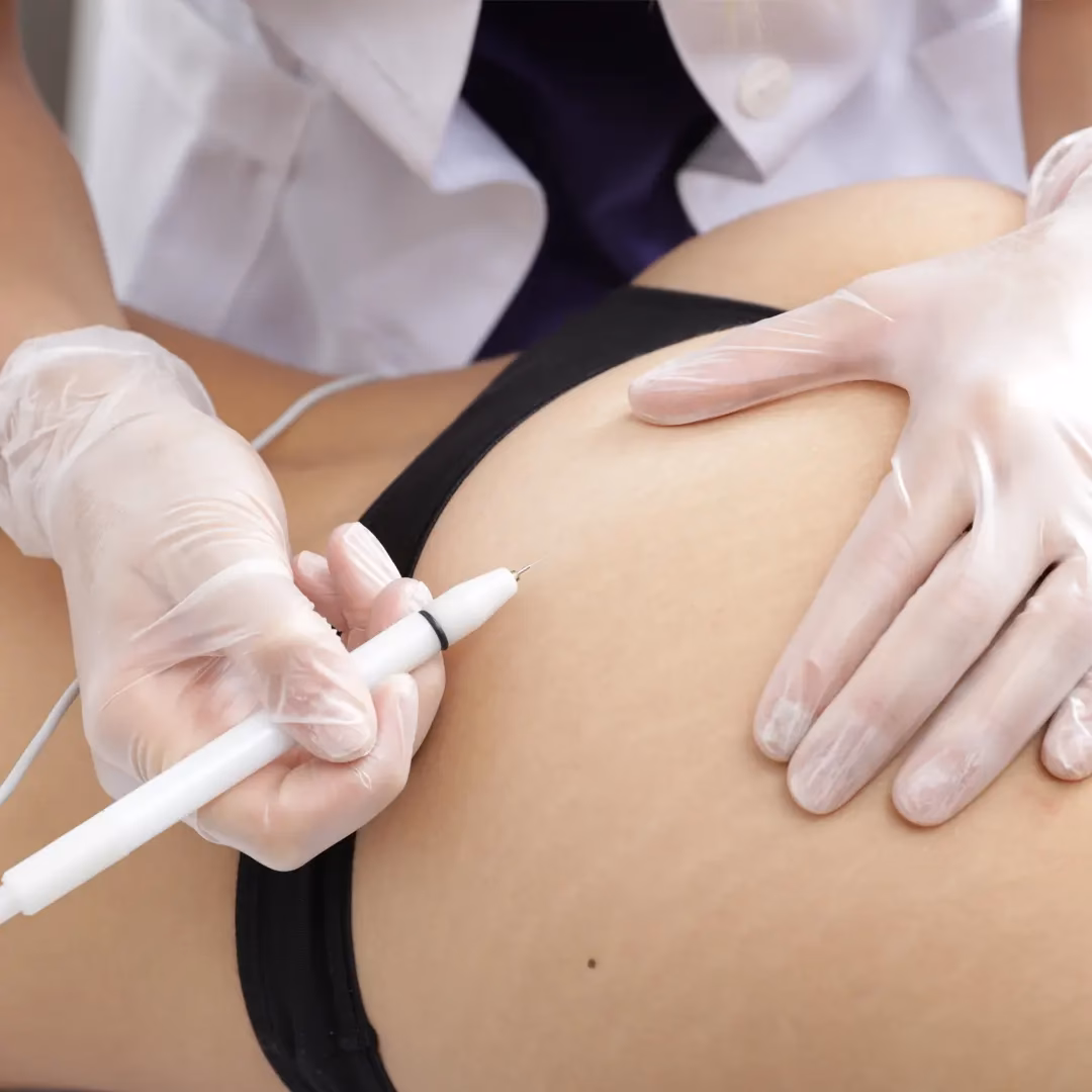 ¿Qué es el tratamiento de micropuntura para las estrías?