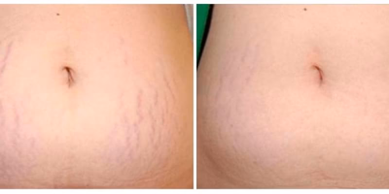 ¿Puede la acupuntura ayudar con las estrías?