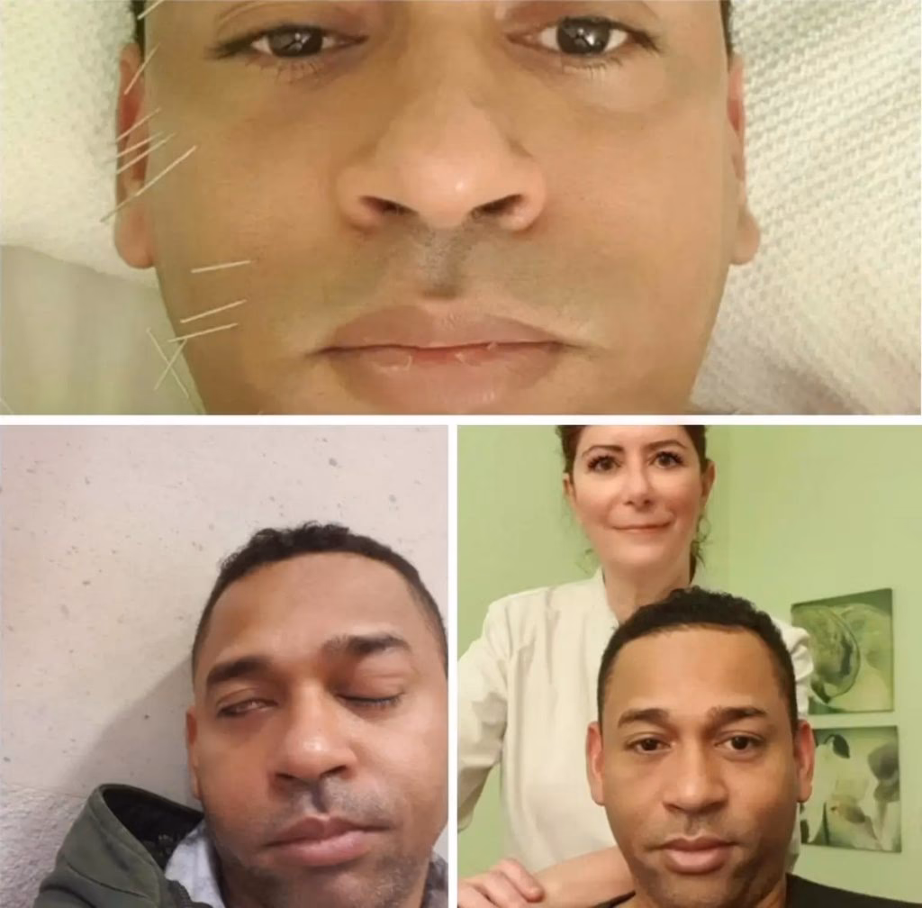 ¿Qué tan efectiva es la acupuntura para la parálisis facial?