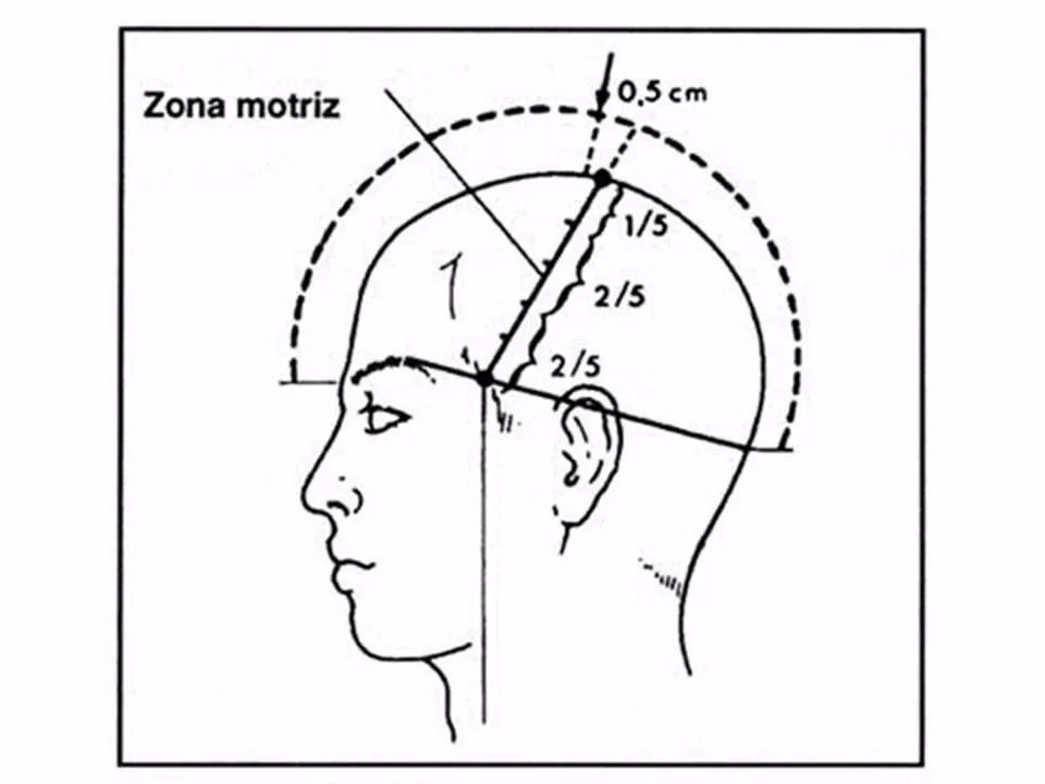 ¿Cómo sanar una hemiplejia?