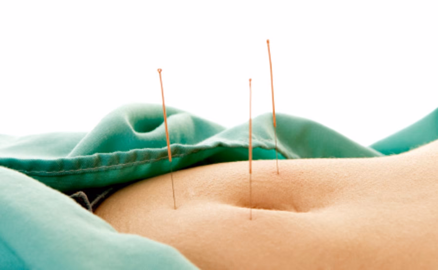 Can acupuncture help indigestion?