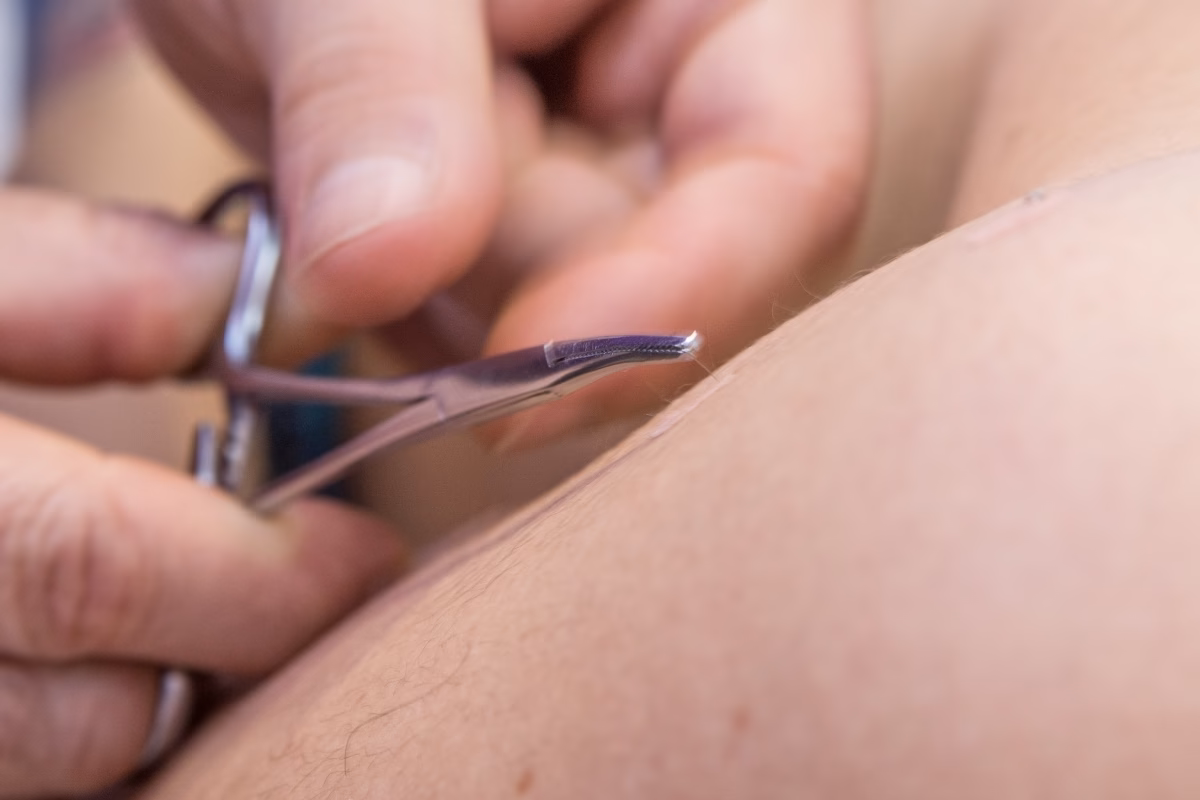 ¿Qué es la acupuntura intradérmica?