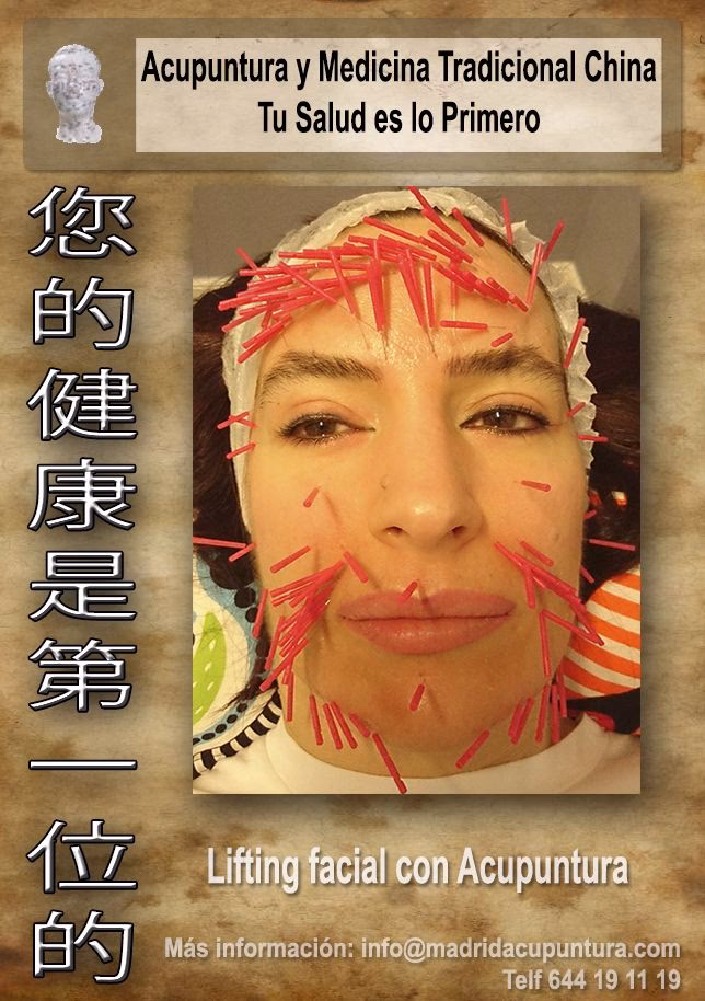 Where is the acupuncture point for face lifting?