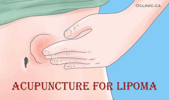 Does fat freezing work on lipomas?