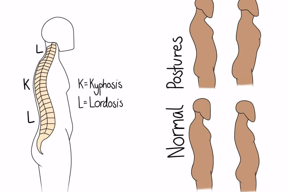 Does lordosis cause the stomach to stick out?