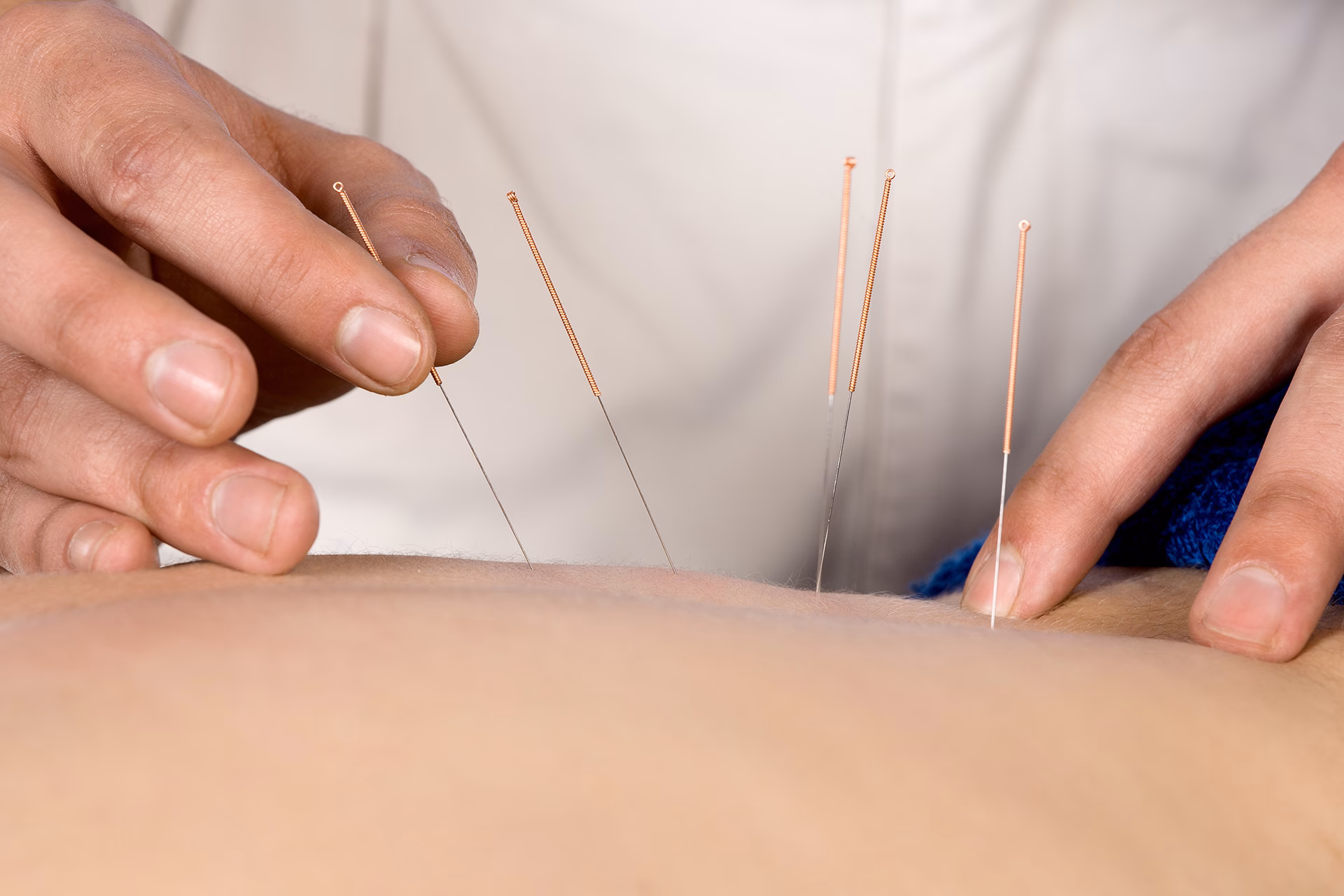 ¿Es segura la acupuntura en la cabeza?