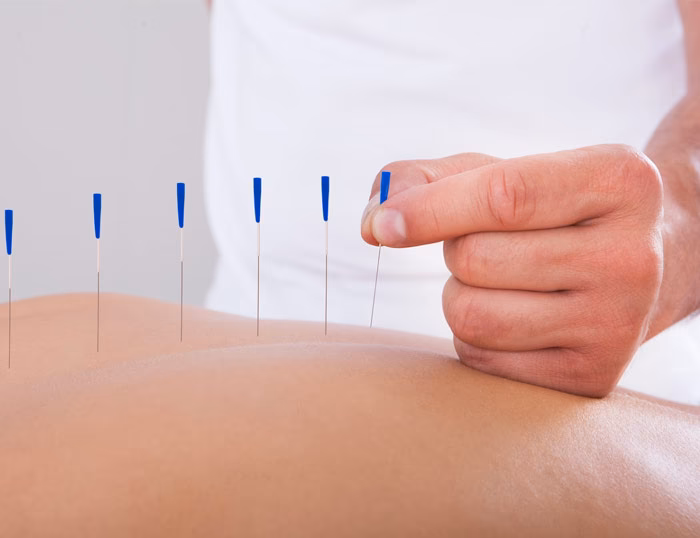 ¿La acupuntura ayuda a la médula espinal?