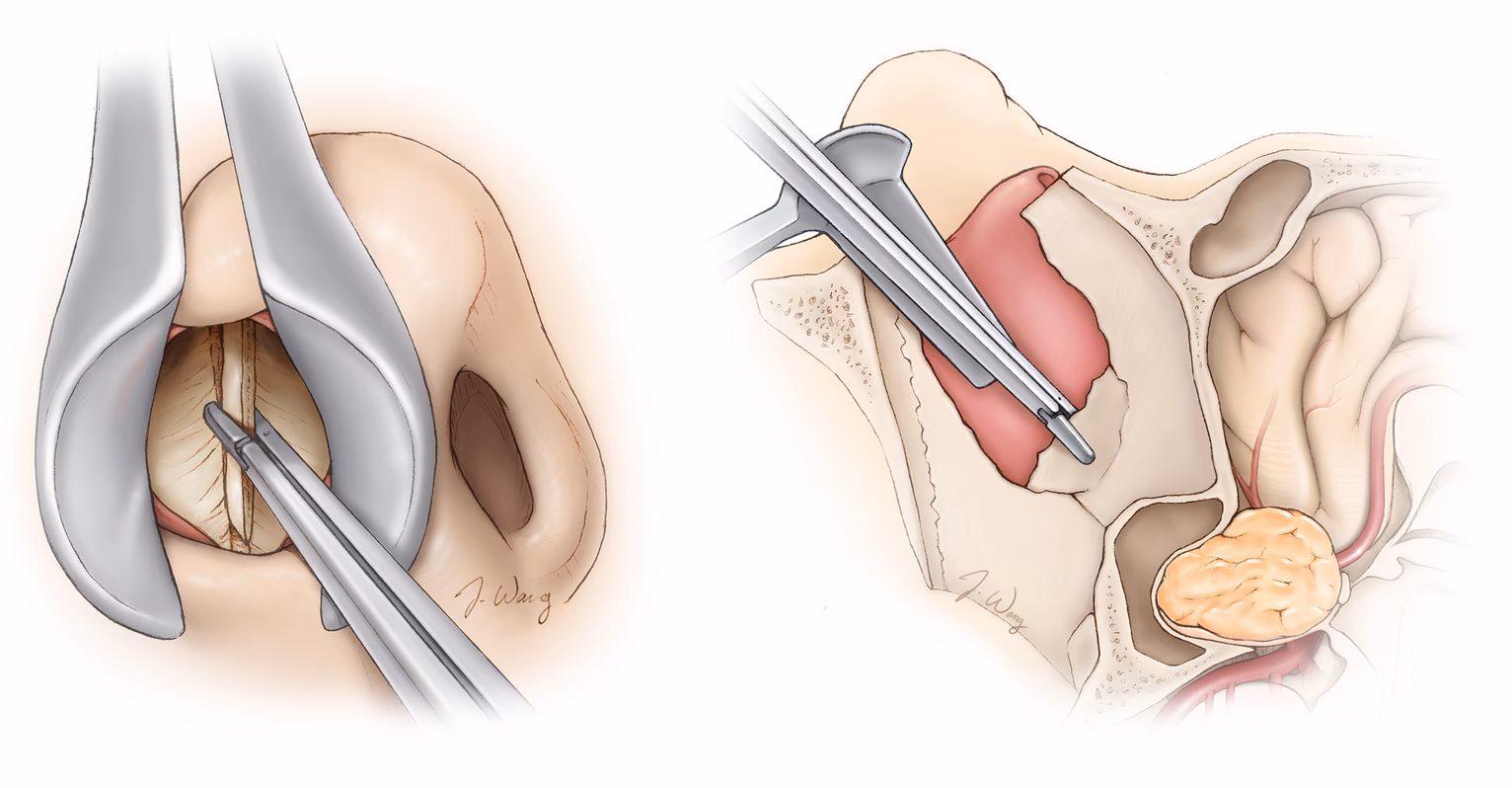 ¿Cuál es el tratamiento para los tumores de hipófisis?