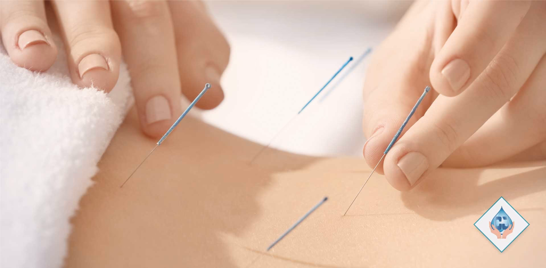 ¿Cuántos kilos se bajan con la acupuntura?