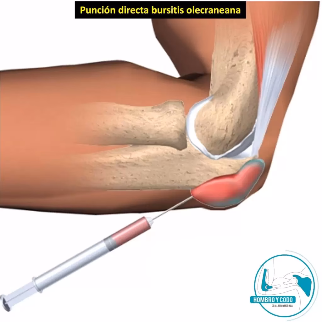 ¿Cómo curar la bursitis olecraneana?