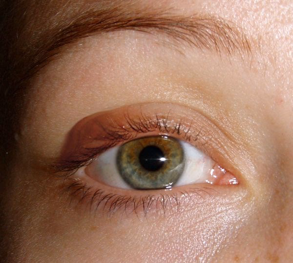 What worsens a chalazion?