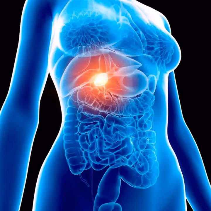 ¿Qué es bueno para desinflamar la colecistitis?