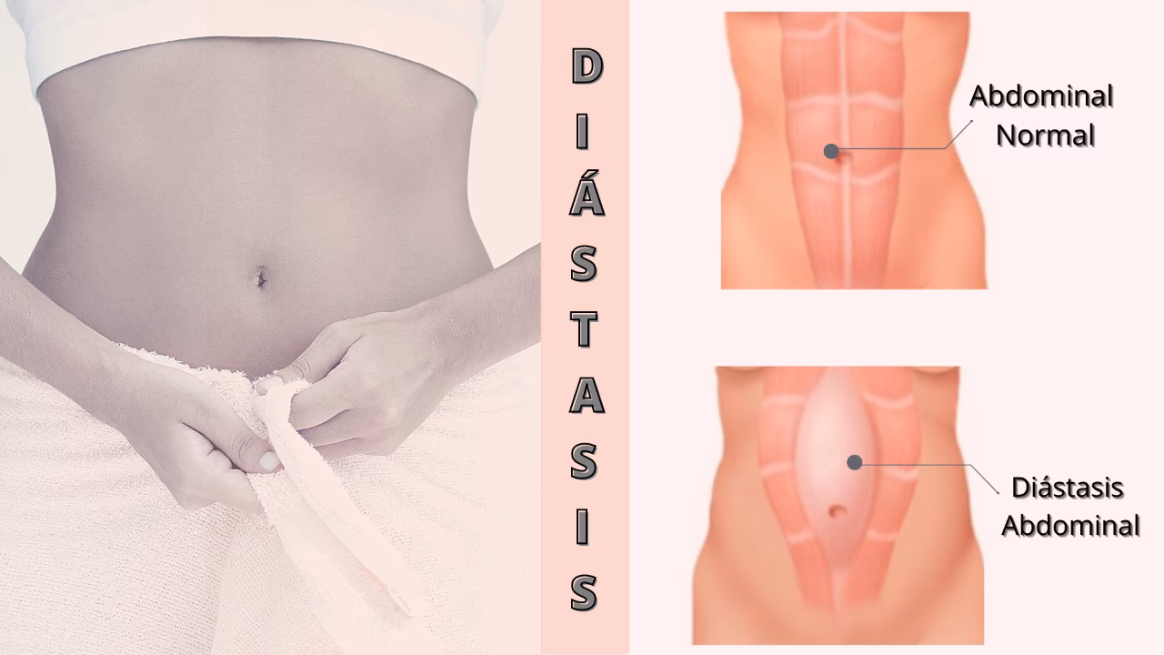 ¿Cómo eliminar la diástasis abdominal sin cirugía?
