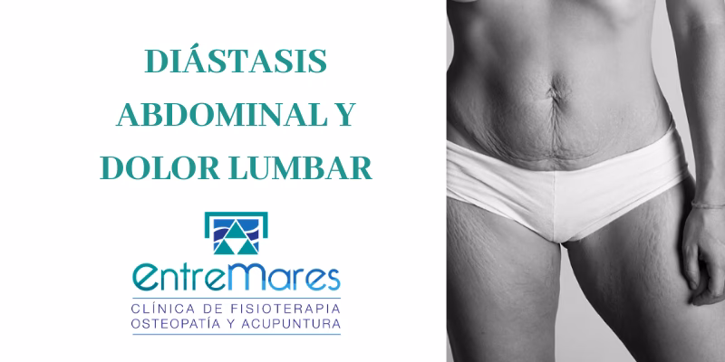 ¿Cómo bajar la panza si tengo diástasis abdominal?