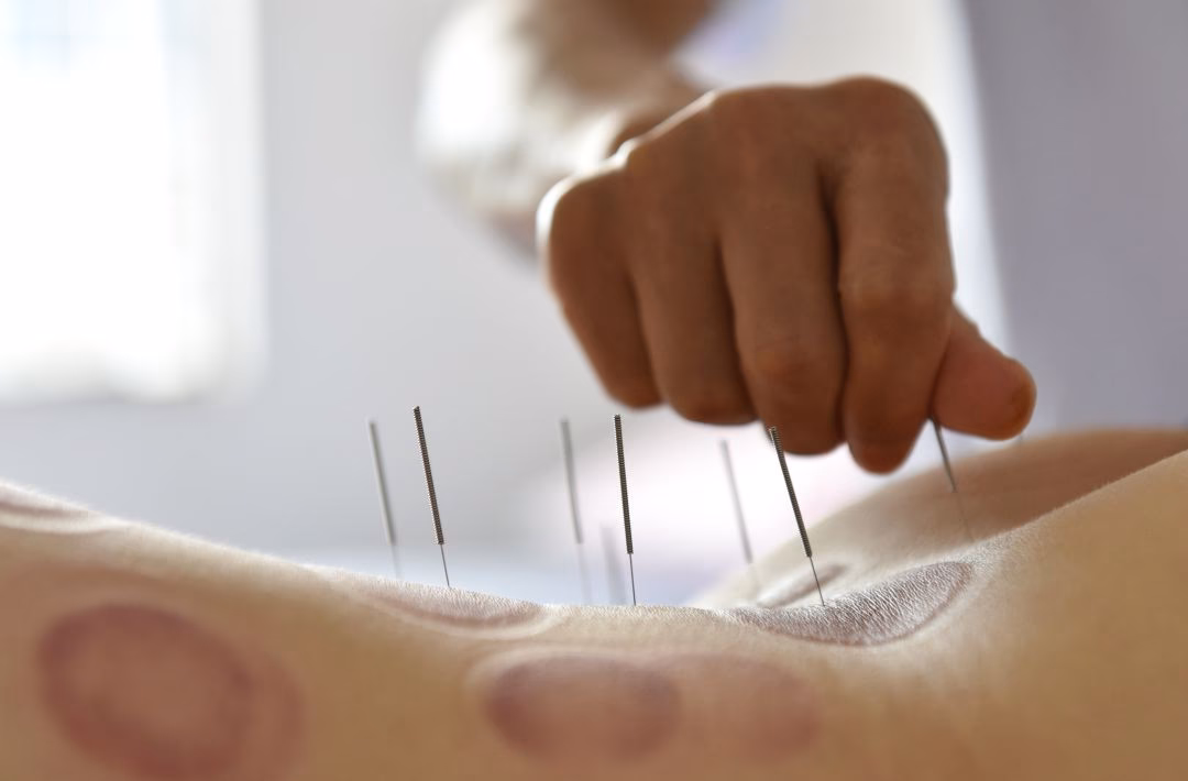 ¿Puede la acupuntura ayudar con la discapacidad?