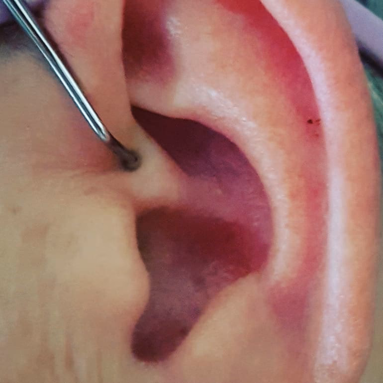 ¿Qué puntos de acupuntura se estimulan para el dolor menstrual?