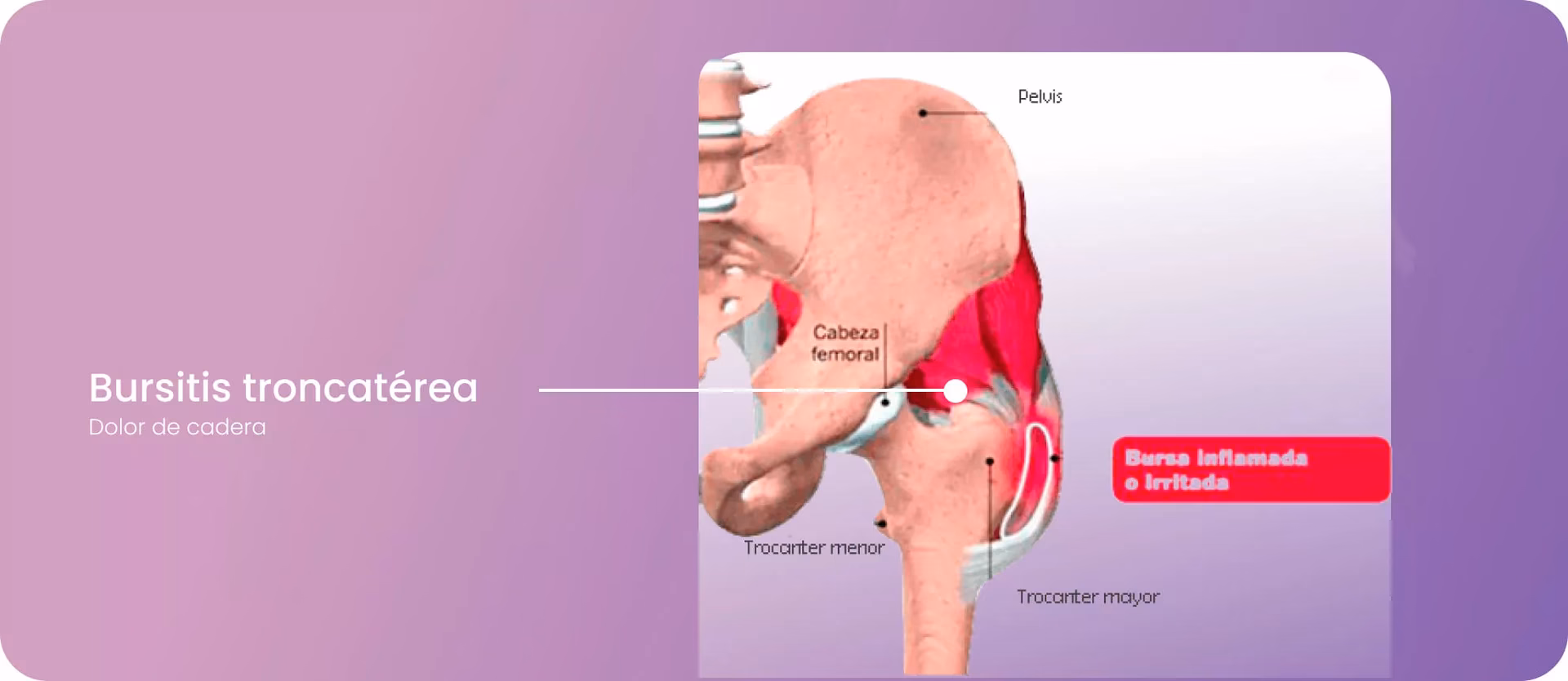 ¿Qué hacer para el dolor de abductor?