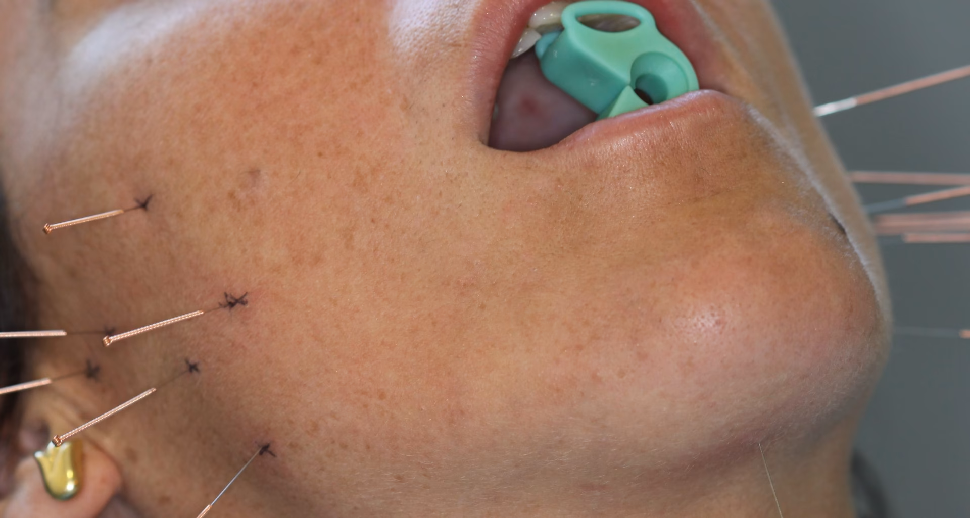 ¿Qué hierba es buena para el bruxismo?