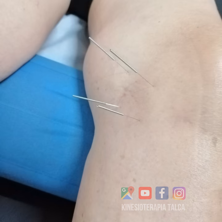 ¿Cómo curar un esguince en la rodilla rápido?