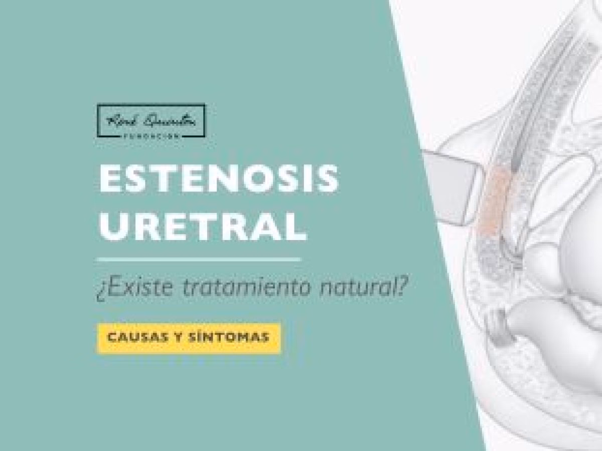 ¿Cómo curar la estenosis uretral sin cirugía?