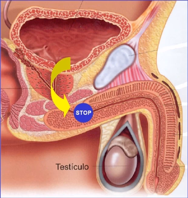 ¿Qué sirve para la estenosis uretral?