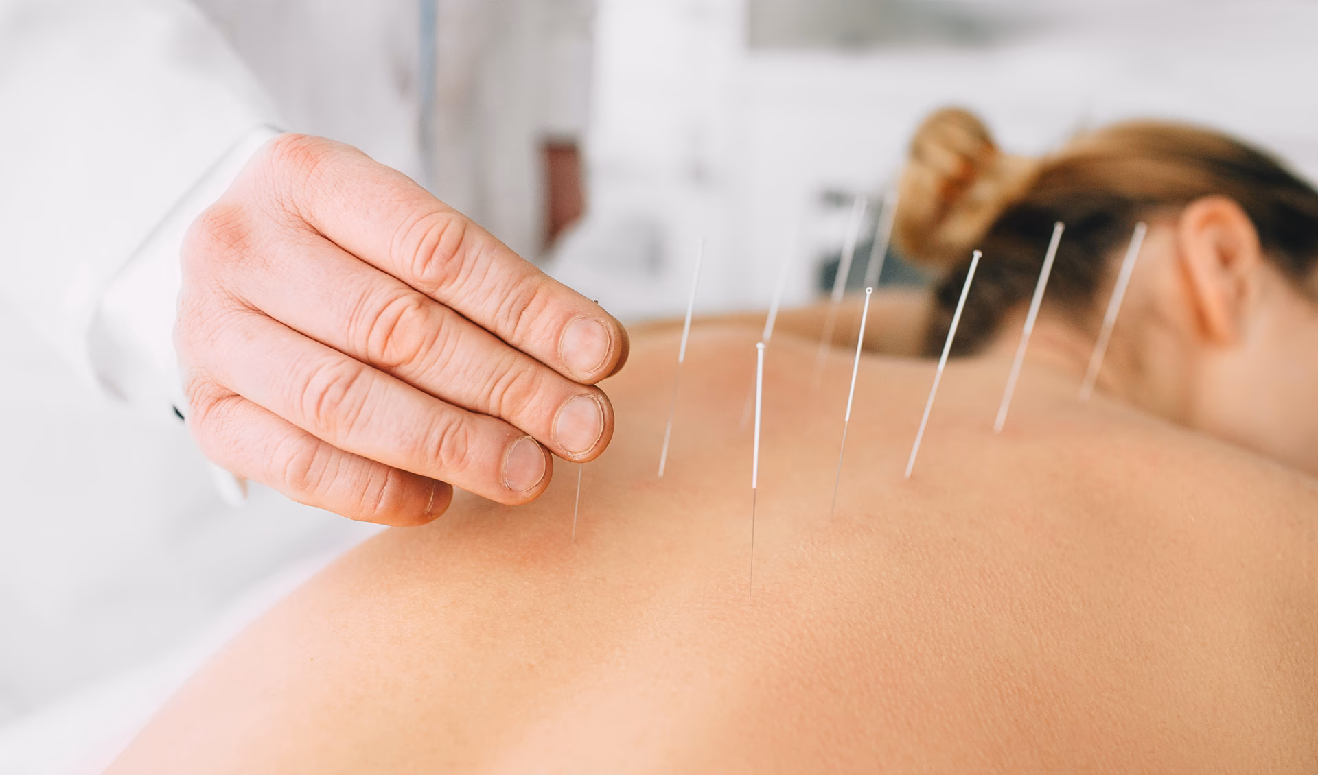 Como funciona a acupuntura para fertilidade?