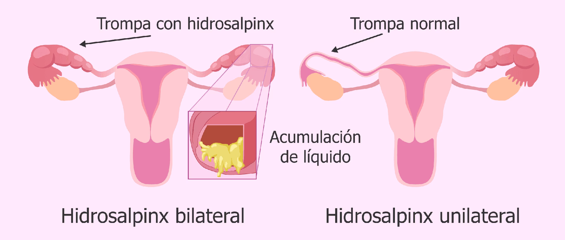 ¿Qué pasa si no me opero de hidrosalpinx?