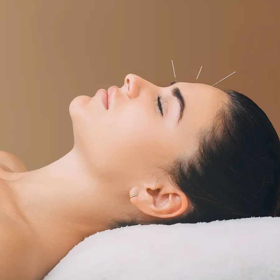 ¿Puede la acupuntura curar la hiperhidrosis?